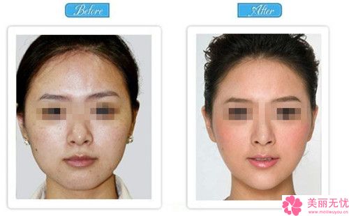 电动负压吸脂术脸部抽脂瘦脸整形手术危险吗