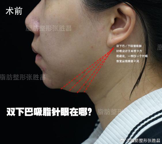 脸部抽脂瘦脸效果自然吗_电动负压脸部抽脂后遗症_面部吸脂术会反弹吗