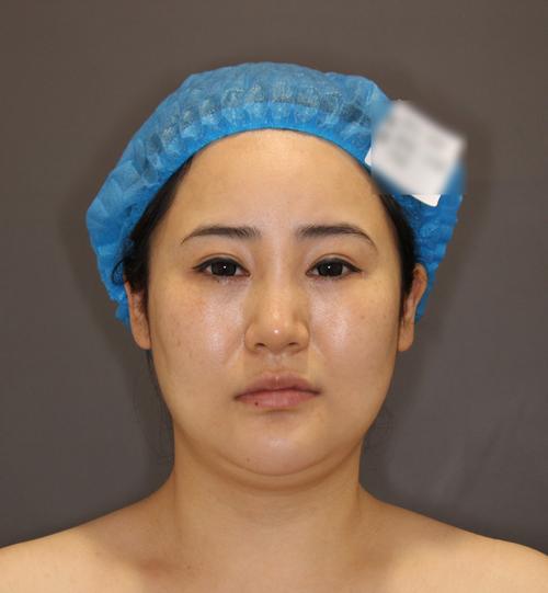 面部吸脂术后恢复日记_面部吸脂术会反弹吗_钻石吸脂术面部塑形效果